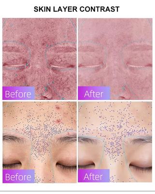 comprar Blue Light Acne Treatment Mask with Intelligent Timer – Manufacturer Direct Supply, Appearance Patent Included fabricación en línea